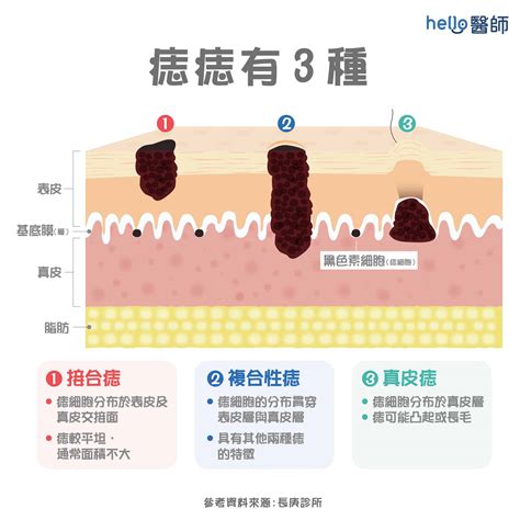 陰莖長痣|痣形成的原因？痣長毛、痣變多變大是痣病變？5招判別